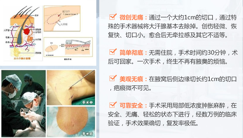 广州乔贵宾教授5月13日手汗症讲座,广州仁爱医院-微创手术治